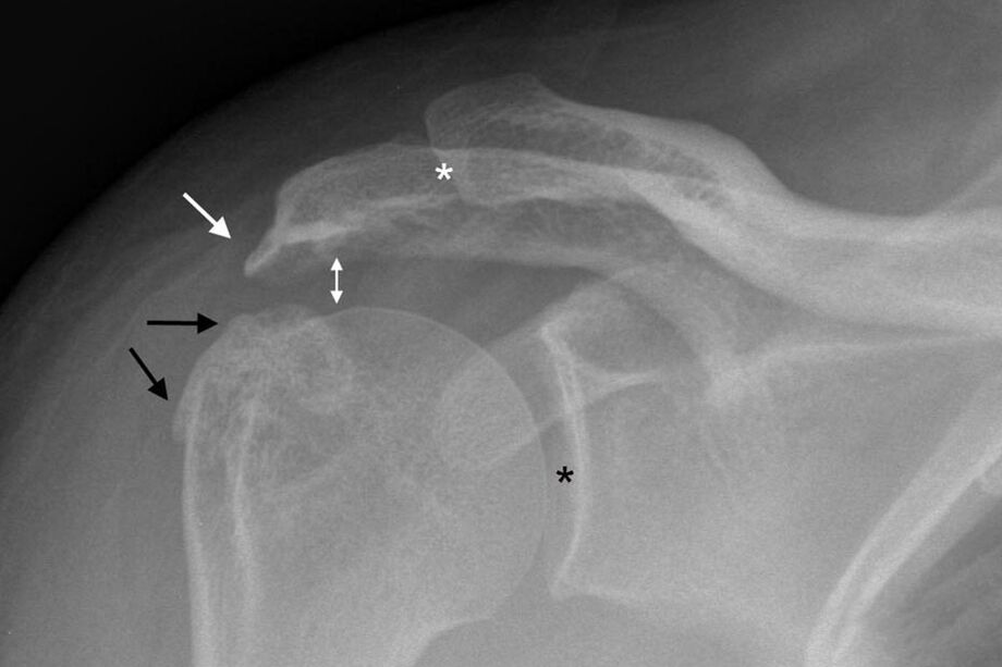 sorbalda artikulazioaren artrosia X izpietan
